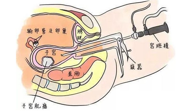 宮腔鏡檢查方法以及正常宮腔圖像